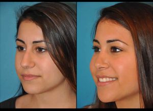 before after Rhinoplasty 1