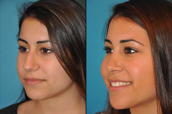 before after Rhinoplasty 1