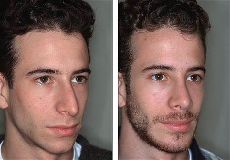 before after Rhinoplasty 2