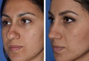 before after Rhinoplasty 3 e1611494460633