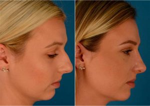 before after Rhinoplasty 4