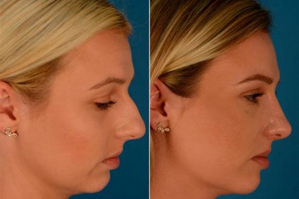 before after Rhinoplasty 4