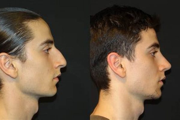 before after Rhinoplasty 5