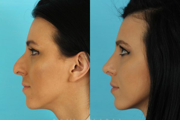 before after Rhinoplasty 6