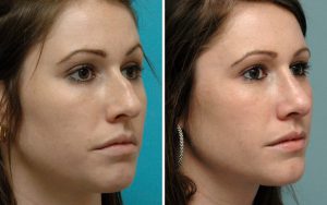 before after Rhinoplasty 7