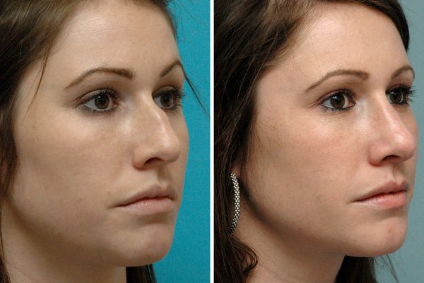 before after Rhinoplasty 7