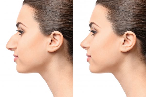 before after Rhinoplasty 8