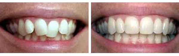 before after cosmetic dentistry 1 e1610630989814