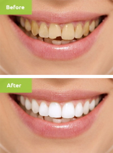 before after cosmetic dentistry 1