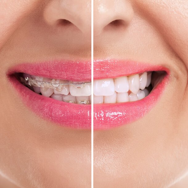 before after cosmetic dentistry 2