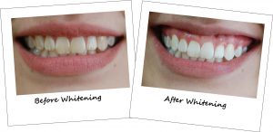 before after cosmetic dentistry 3