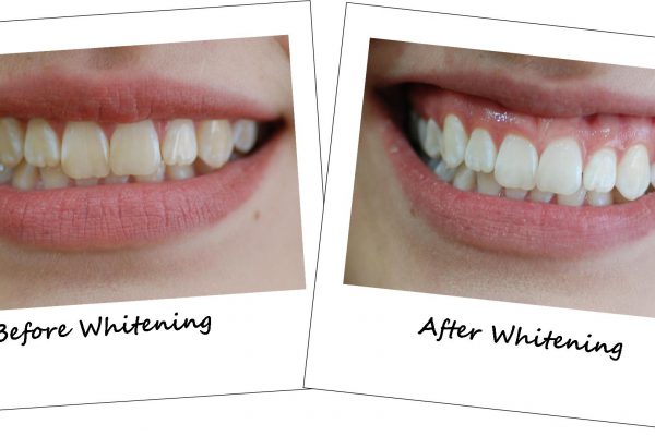 before after cosmetic dentistry 3