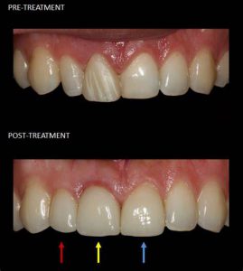 before after cosmetic dentistry 4