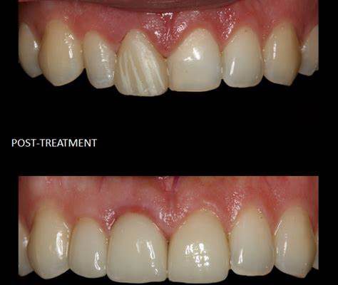 before after cosmetic dentistry 4