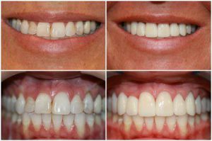 before after cosmetic dentistry 5