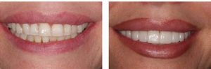 before after cosmetic dentistry 6 e1610631012475