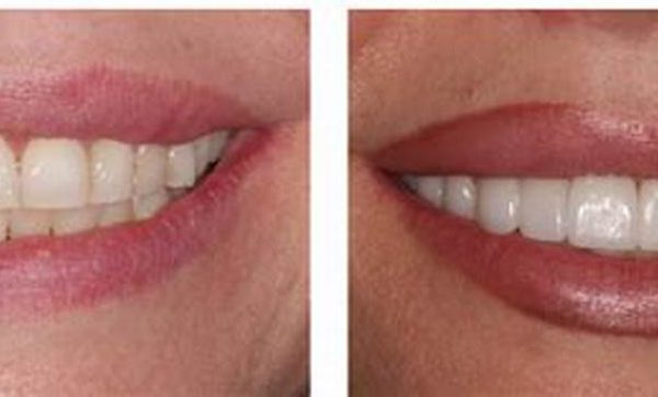 before after cosmetic dentistry 6 e1610631012475