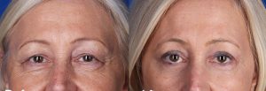before after eylid surgery 5 e1610631371728