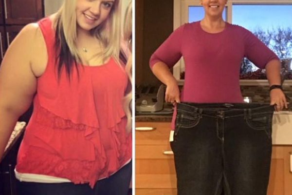 before after weight loss surgery 2