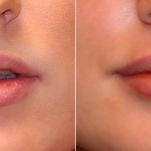 lip Augmentation 1
