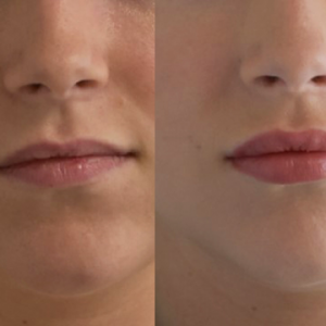 lip Augmentation 1