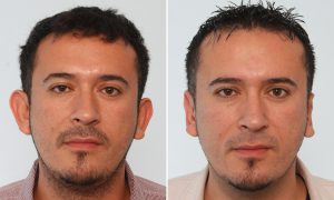 otoplasty before after 4