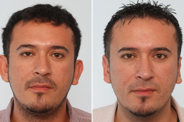 otoplasty before after 4