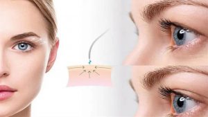 Eyelid Surgery in Iran