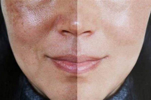 melasma treatment in iran2