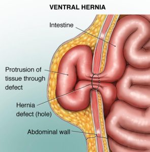 Hernia Treatment in Iran 8
