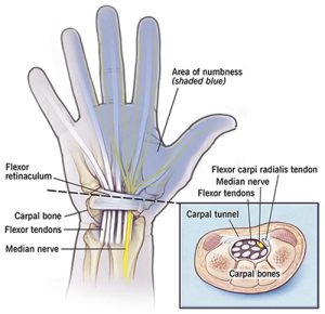 carpal tunnel syndrome CTS