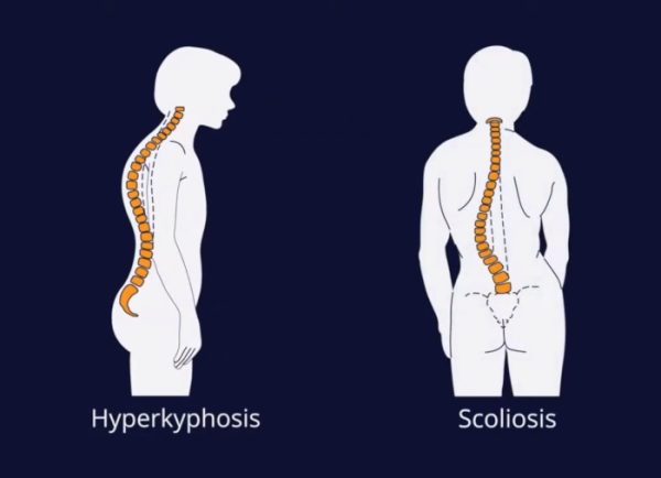 Spine Surgery in Iran