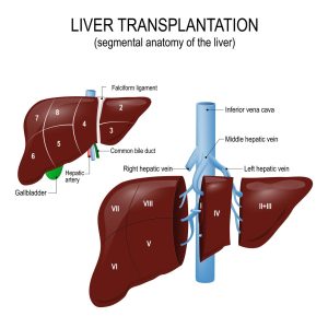 liver transplantation in iran