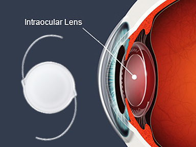 Intraocular Lens Implantation in iran