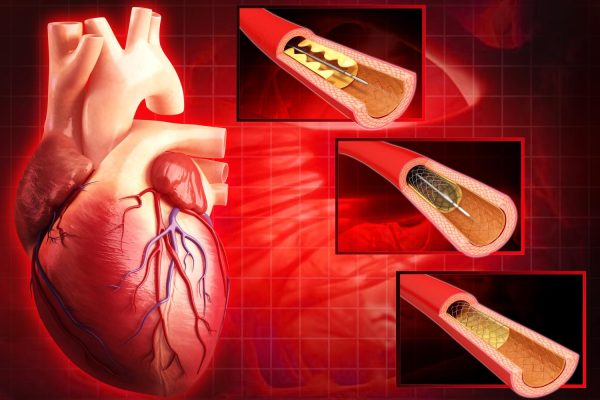 Angioplasty in Iran