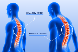 Kyphosis Treatment in Iran