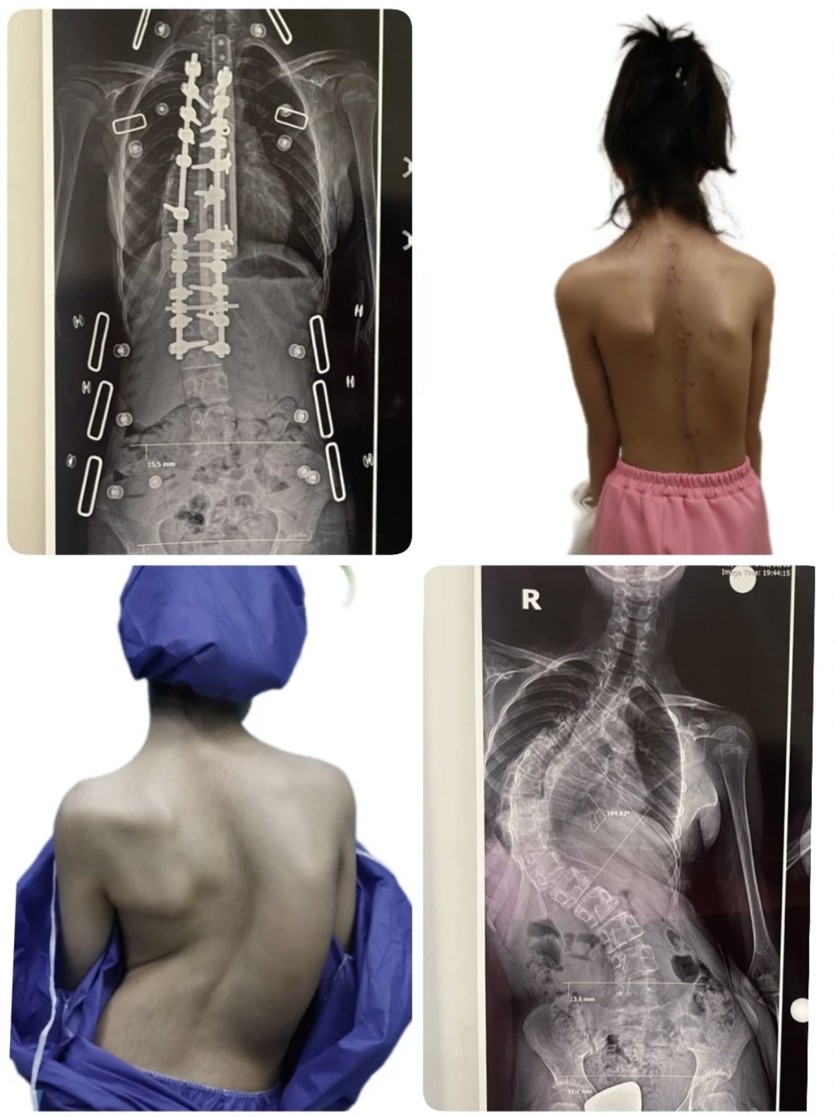 Scoliosis Surgery in Iran e1732594524802