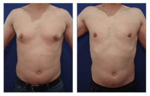 gynecomastia surgery in iran