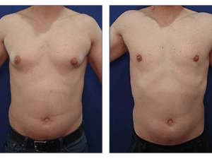 gynecomastia surgery in iran