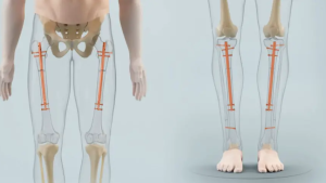 Iran Limb Lengthening Treatmen