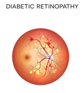 Diabetic Retinopathy