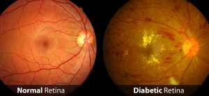 Diabetic Retinopathy Treatment