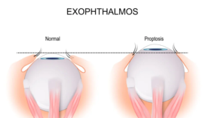 Exophthalmos Bulging Eyes Treatment in iran e1735654493480