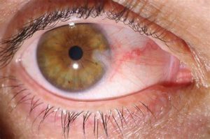 Pterygium surgery in iran