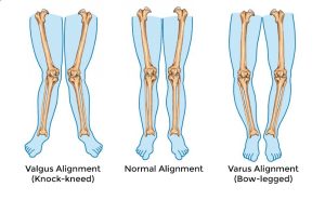 bowlegs corection in iran