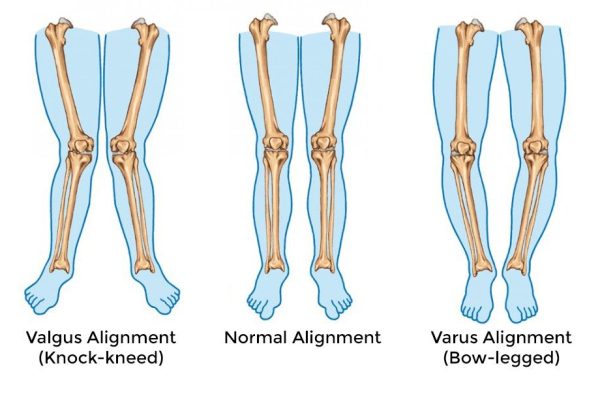 bowlegs corection in iran