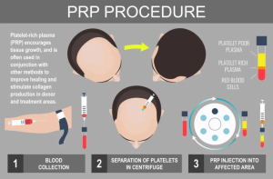 prp hair loss.jpg