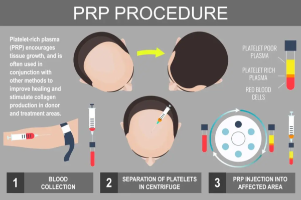 prp hair loss.jpg