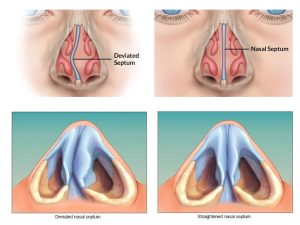 septoplasty in iran 2