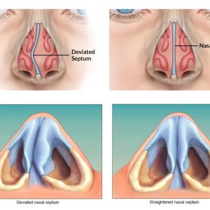 septoplasty in iran 2